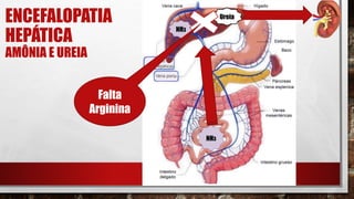 ENCEFALOPATIA
HEPÁTICA
AMÔNIA E UREIA
NH3
NH3
Ureia
Falta
Arginina
 