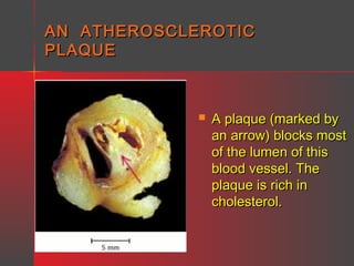AN ATHEROSCLEROTIC
PLAQUE



A plaque (marked by
an arrow) blocks most
of the lumen of this
blood vessel. The
plaque is rich in
cholesterol.

 