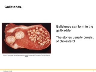 © McGraw Hill, LLC
Gallstones2
Clinical Photography, Central Manchester University Hospitals NHS Foundation Trust, UK/Science
Source
Gallstones can form in the
gallbladder
The stones usually consist
of cholesterol
70
 