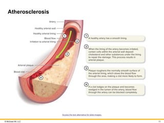 © McGraw Hill, LLC
Atherosclerosis
Access the text alternative for slide images.
83
 