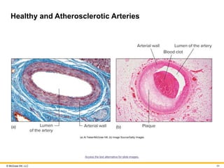 © McGraw Hill, LLC
Healthy and Atherosclerotic Arteries
(a) Al Telser/McGraw Hill; (b) Image Source/Getty Images
Access the text alternative for slide images.
84
 