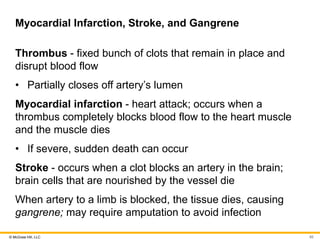 © McGraw Hill, LLC
Myocardial Infarction, Stroke, and Gangrene
Thrombus - fixed bunch of clots that remain in place and
disrupt blood flow
• Partially closes off artery’s lumen
Myocardial infarction - heart attack; occurs when a
thrombus completely blocks blood flow to the heart muscle
and the muscle dies
• If severe, sudden death can occur
Stroke - occurs when a clot blocks an artery in the brain;
brain cells that are nourished by the vessel die
When artery to a limb is blocked, the tissue dies, causing
gangrene; may require amputation to avoid infection
85
 