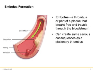 © McGraw Hill, LLC
Embolus Formation
• Embolus - a thrombus
or part of a plaque that
breaks free and travels
through the bloodstream
• Can create same serious
consequences as a
stationary thrombus
86
 