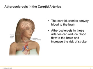 © McGraw Hill, LLC
Atherosclerosis in the Carotid Arteries
• The carotid arteries convey
blood to the brain
• Atherosclerosis in these
arteries can reduce blood
flow to the brain and
increase the risk of stroke
87
 
