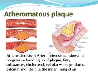 Atherosclerosis or Arteriosclerosis is a slow and
progressive building up of plaque, fatty
substances, cholesterol, cellular waste products,
calcium and fibrin in the inner lining of an
 
