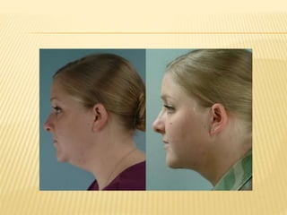 LIPOSUCTION oleh Dr Retno Indrastiti,SpKK