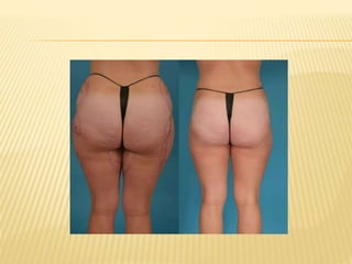 LIPOSUCTION oleh Dr Retno Indrastiti,SpKK