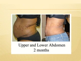 LIPOSUCTION oleh Dr Retno Indrastiti,SpKK