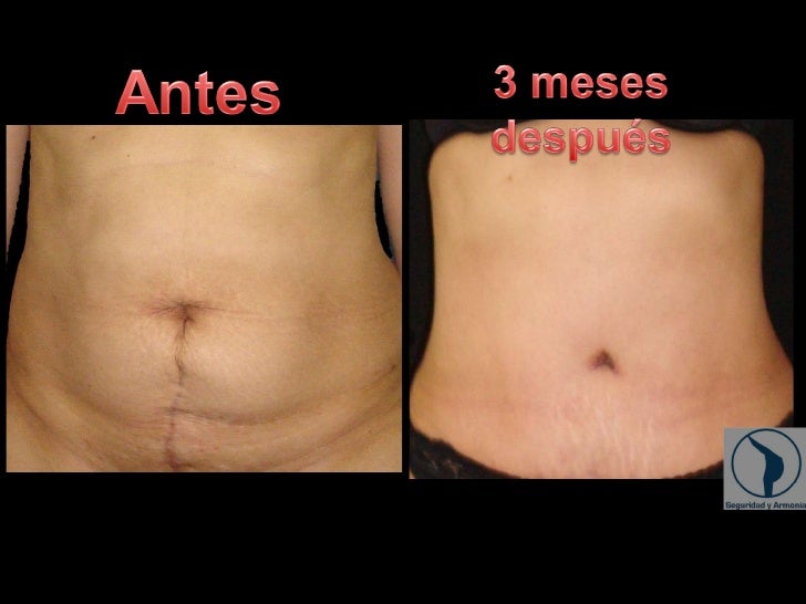 Qual A Diferença Entre Abdominoplastia E Lipo - Insights e Informações