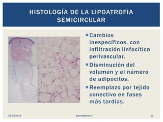HISTOLOGÍA DE LA LIPOATROFIA
SEMICIRCULAR
Cambios
inespecíficos, con
infiltración linfocítica
perivascular.
Disminución del
volumen y el número
de adipocitos.
Reemplazo por tejido
conectivo en fases
más tardías.
jhauva@achs.cl22-05-2013 11
 