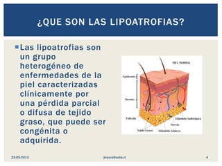 Las lipoatrofias son
un grupo
heterogéneo de
enfermedades de la
piel caracterizadas
clínicamente por
una pérdida parcial
o difusa de tejido
graso, que puede ser
congénita o
adquirida.
¿QUE SON LAS LIPOATROFIAS?
jhauva@achs.cl22-05-2013 4
 