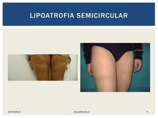 LIPOATROFIA SEMICIRCULAR
jhauva@achs.cl22-05-2013 9
 