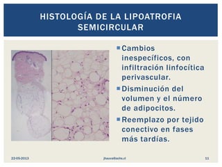 HISTOLOGÍA DE LA LIPOATROFIA
SEMICIRCULAR
Cambios
inespecíficos, con
infiltración linfocítica
perivascular.
Disminución ...