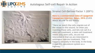 Stromal Cell-Derived Factor 1 (SDF1)
Here is a commentated video of Lipogems®
Lipoaspirate injection, Malan, 2016 (CLICK
I...