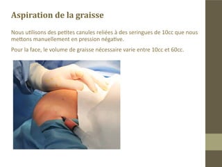 Instrumentation pour le prélèvement graisseux

Nous utilisons des petites canules de
lipoaspiration reliées à des
seringues de 10 ou 5cc.
 