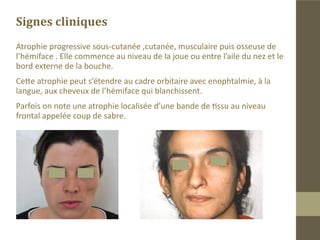 Généralités
„„   Maladie orpheline
 Étiologie mal connue : Maladie auto immune? Génétique?
„„

dysraphie ? Sclérodermie ?
„„   Prédominance féminine
„„   Intéresse le plus souvent le coté gauche de la face.
„„   Évolue entre 2-20ans
„„   Au USA 200 000 cas dans la population(NIH 2009)
„„   Pas de statistiques en Algérie, 27 cas rencontrés en 15 ans .
 