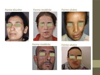 Les formes cliniques

Selon les cas rencontrés nous proposons la classification suivante:
„„   La forme discrète:
L’atrophie intéresse une petite surface de la face sans aucun autre signe.
„„   La forme modérée:
L’atrophie est localisée avec enfoncement de la joue visible, elle peut être
est étendue à toute l’hémiface, sans déformation de la bouche ou de l’or-
bite oculaire.
„„La forme sévère:
Lorsque il y a atteinte osseuse avec déformation de l’œil , la bouche et
latéro-déviation mandibulaire.
 