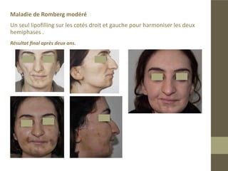 Cas de maladie de Romberg modéré
Patiente ayant nécessité un second comblement après 3 mois.
Résultat final après deux ans .
 