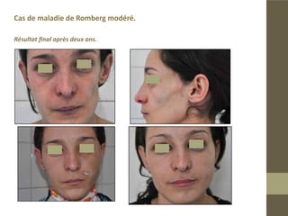 Maladie de Romberg modéré
Un seul lipofilling sur les cotés droit et gauche pour harmoniser les deux
hemiphases .
Résultat final après deux ans.
 