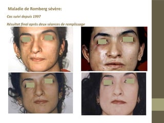 Cas de maladie de Romberg modéré.

Résultat final après deux ans.
 