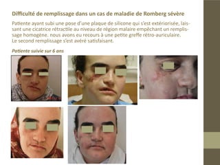 Maladie de Romberg sévère:
Cas suivi depuis 1997

Résultat final après deux séances de remplissage
 