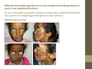 Difficulté de remplissage dans un cas de maladie de Romberg sévère
Patiente ayant subi une pose d’une plaque de silicone qui s’est extériorisée, lais-
sant une cicatrice rétractile au niveau de région malaire empêchant un remplis-
sage homogène. nous avons eu recours à une petite greffe rétro-auriculaire.
Le second remplissage s’est avéré satisfaisant.
Patiente suivie sur 6 ans
 