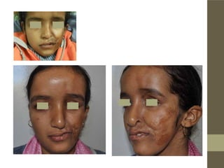 Difficulté de remplissage dans un cas de maladie de Romberg sévère as-
socié à une séquelle de brûlure :
Ce cas a nécessité une greffe cutanée au niveau de la séquelle de brûlure
qui a permis un remplissage homogène en deux séances .
Patiente suivie sur 6 ans
 