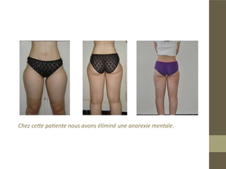 Lipoaspiration de la culotte de cheval,remplissage avec la graisse liposuc-
cée au niveau trochonterien.
Résultat final après trois ans
 
