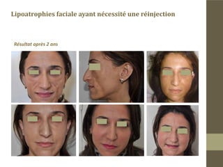 Chez cette patiente nous avons éliminé une anorexie mentale.
 