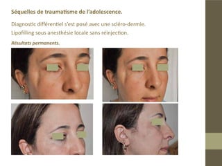 Lipofilling dans
        les lésions
post-traumatiques
 