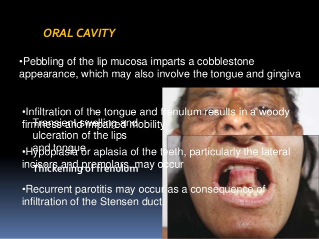 Lipoid proteinosis- Urbach wiethe disease - A rare case... dr.suresh