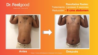 Resultados Reales:
Tratamiento: Lipolaser 10 sesiones
Reducción: - 7 cms abdomen
Antes Despuéshttps://www.drfeelgood.cl/li...