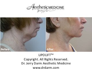 Before                    After
                     LIPOLIFTTM
          Copyright. All Rights Reserved.
         Dr. Jerry Darm Aesthetic Medicine
                  www.drdarm.com
 