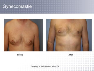 Courtesy of Jeff Schafer, MD – CA Gynecomastie Before After 