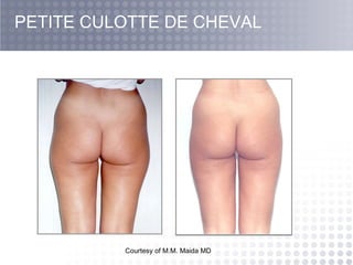 Courtesy of M.M. Maida MD  PETITE CULOTTE DE CHEVAL 