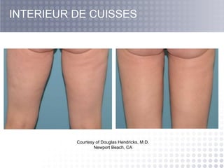Courtesy of Douglas Hendricks, M.D. Newport Beach, CA INTERIEUR DE CUISSES 