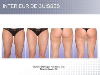 Courtesy of Douglas Hendricks, M.D. Newport Beach, CA INTERIEUR DE CUISSES 