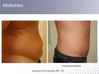 Courtesy of John Decorato, MD – NY  Abdomen 1 month post treatment 