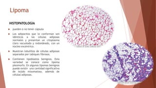 Lipoma
HISTOPATOLOGIA
 pueden o no tener cápsula
 Los adipocitos que lo conforman son
idénticos a las células adiposas
n...
