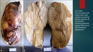 (a) A well-
circumscribed soft
tumor with outer
surface covered by
fibrous capsule. (b)
Cut section
showing yellowish,
greasy solid tumor
with lobulated
appearance
 