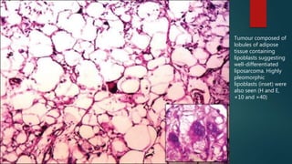 Tumour composed of
lobules of adipose
tissue containing
lipoblasts suggesting
well-differentiated
liposarcoma. Highly
pleomorphic
lipoblasts (inset) were
also seen (H and E,
×10 and ×40)
 