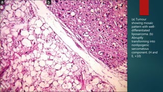 (a) Tumour
showing mosaic
pattern with well-
differentiated
liposarcoma. (b)
Abruptly
transforming into
nonlipogenic
sarcomatous
component. (H and
E, ×10)
 
