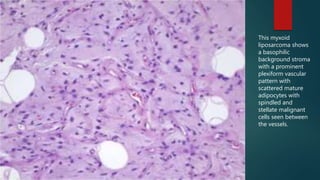 This myxoid
liposarcoma shows
a basophilic
background stroma
with a prominent
plexiform vascular
pattern with
scattered mature
adipocytes with
spindled and
stellate malignant
cells seen between
the vessels.
 