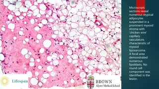 Microscopic
sections reveal
numerous atypical
adipocytes
suspended in a
prominent myxoid
stroma with
‘chicken wire’
capillary
vasculature,
characteristic of
myxoid
liposarcoma.
A focal area
demonstrated
numerous
lipoblasts. No
round cell
component was
identified in the
lesion.
 