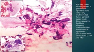 Cytology smears
showing clusters of
pleomorphic
spindle to round
cells. Many
multinucleated
tumor giant cells
(upper inset);
bizarre appearing
lipoblasts
displaying
scalloped nucleus
having multiple
cytoplasmic
vacuolations (lower
inset) (H and E, ×20
and ×40)
 
