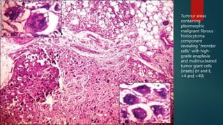 Tumour areas
containing
pleomorphic
malignant fibrous
histiocytoma
component
revealing “monster
cells” with high-
grade anaplasia
and multinucleated
tumor giant cells
(insets) (H and E,
×4 and ×40)
 