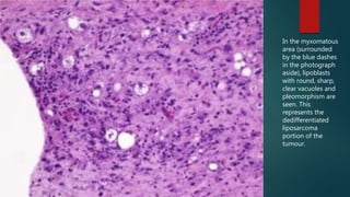 In the myxomatous
area (surrounded
by the blue dashes
in the photograph
aside), lipoblasts
with round, sharp,
clear vacuoles and
pleomorphism are
seen. This
represents the
dedifferentiated
liposarcoma
portion of the
tumour.
 