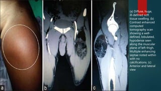 (a) Diffuse, huge,
ill-defined soft
tissue swelling. (b)
Contrast enhanced
computed
tomography scan
showing a well-
defined, lobulated,
hypodense seen
along the muscular
plane of left thigh.
Multiple enhancing
septae noted within
with no
calcifications. (c)
Anterior and lateral
view
 