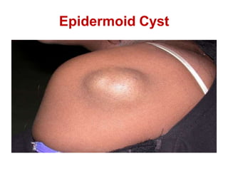 Epidermoid Cyst
 