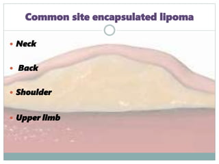 Common site encapsulated lipoma
 Neck
 Back
 Shoulder
 Upper limb
 